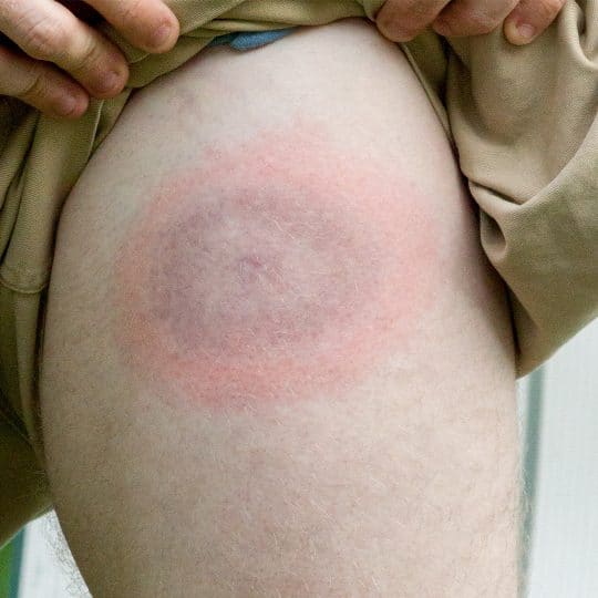 Signs and Symptoms of Lyme Disease