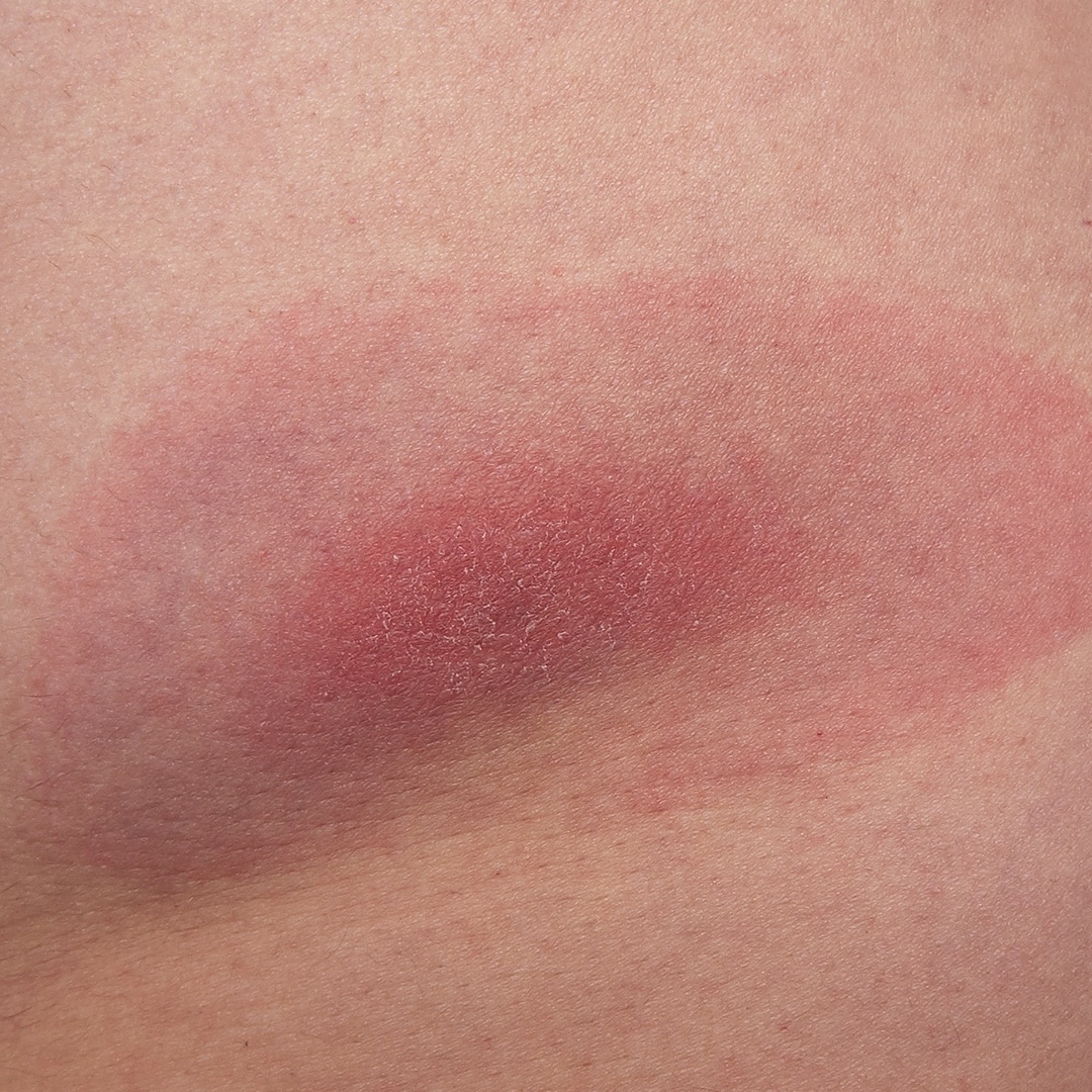 Stages Of Lyme Disease · Extermpro