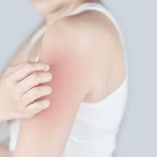 How to Get a Mosquito Bite to Stop Itching